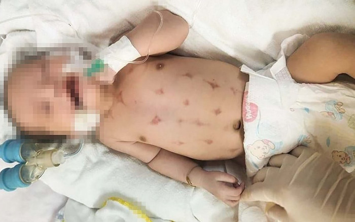 Bé 16 ngày tuổi nguy kịch sau khi được thầy lang 'lể đẹn' Ảnh 2