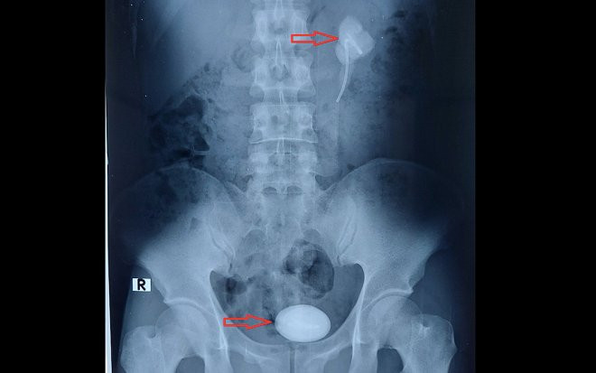 Nam thanh niên nhập viện cấp cứu gấp vì bỏ quên ống thông suốt 5 năm trong niệu quản Ảnh 2