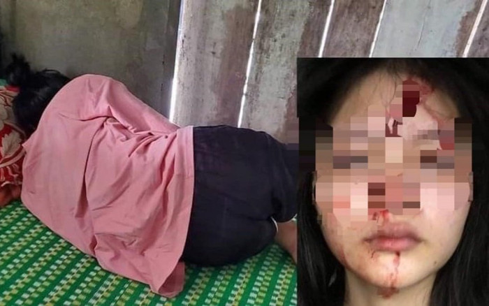 Nữ sinh lớp 10 ở Huế bị bạn cùng trường đánh đến chấn động não Ảnh 2