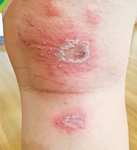 Tổn thương dạng hôn. (Ảnh: Bệnh viện Nhi Trung ương).