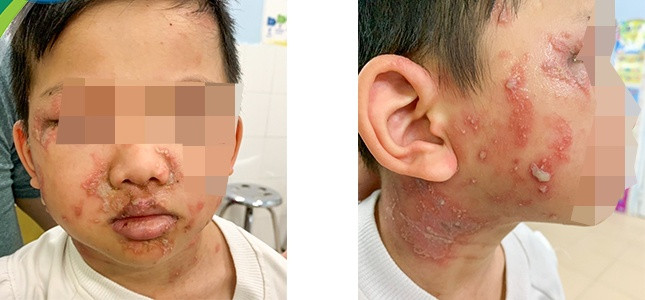 Bé L.V.L. đến khám vì bị kiến ba khoang. (Ảnh: Bệnh viện Nhi Trung ương).