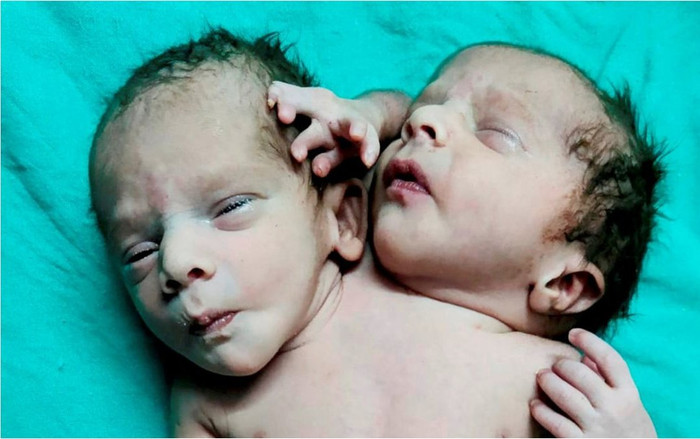 Hy hữu: Mẹ đi siêu âm thai đôi nhưng sinh ra em bé 2 đầu 3 tay Ảnh 2
