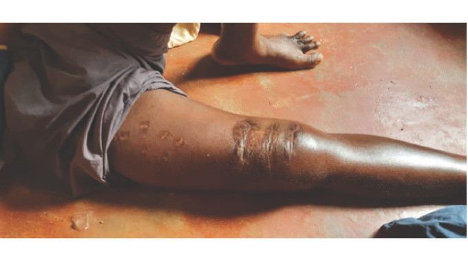 Người đàn ông sống sót sau khi bị ít nhất 3 con cá sấu 'xâu xé', phải thọc cả tay vào miệng con vật Ảnh 5