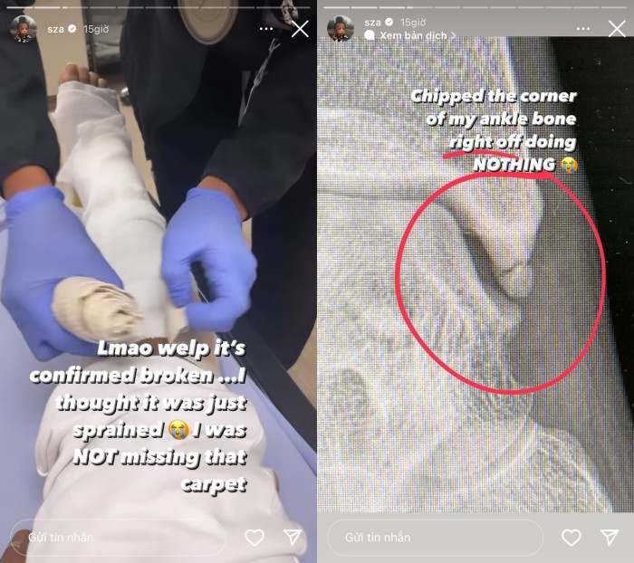 Nữ ca sĩ thông báo bị gãy chân sau khi tham gia một sự kiện Ảnh 5