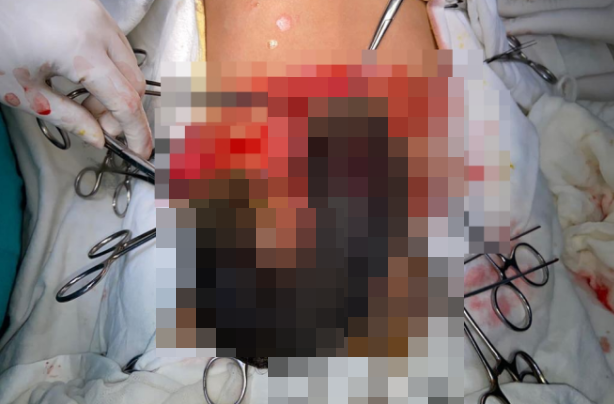 Búi tóc lớn chiếm diện tích dạ dày khiến bé gái bị đau.