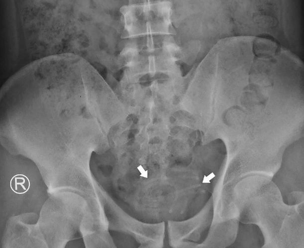 Chụp X-quang vùng chậu cho thấy một bóng mờ hóa ra là một sợi dây.