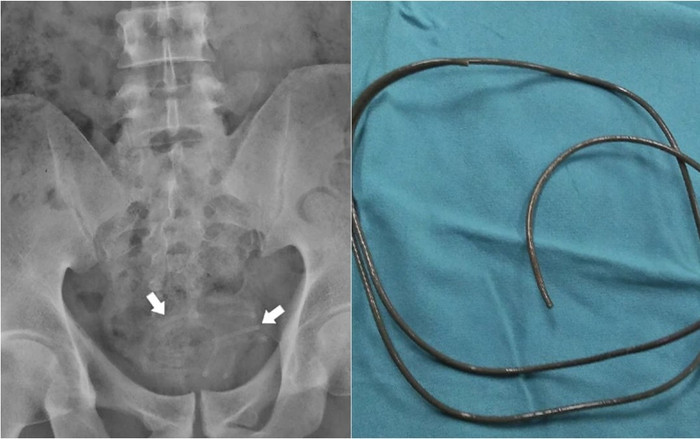 Nhét dây tai nghe vào niệu đạo để tạo khoái cảm, nam thanh niên gặp cái kết đau đớn Ảnh 2