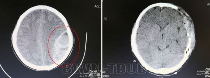 Khối máu tụ của người bệnh (vùng khoanh tròn màu đỏ) trước (hình trái) và sau khi tiến hành phẫu thuật (hình phải). (Ảnh: BVCC).