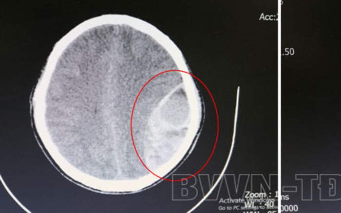 Sau chấn thương vùng đầu, thanh niên chủ quan không đi khám liền rơi vào hôn mê sâu Ảnh 2