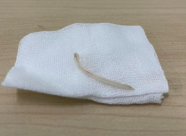 Chiếc xương cá có chiều dài hơn 3,5cm đã được ekip bác sĩ gắp ra ngoài thành công. (Ảnh: Tiền Phong).