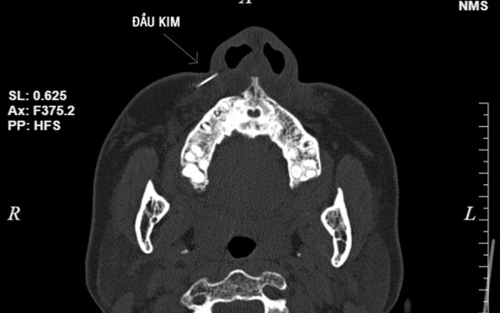 Kim tiêm gãy, mắc toàn bộ trong má người phụ nữ khi tiêm filler làm đẹp ở salon tóc Ảnh 2