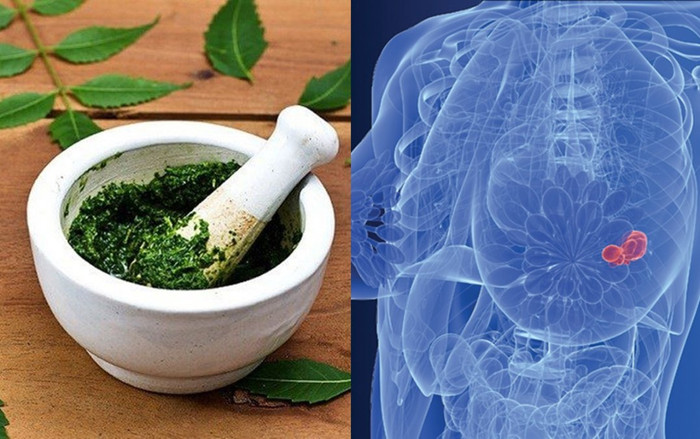 Người phụ nữ vỡ loét đầu ngực vì đắp thuốc nam chữa ung thư vú Ảnh 2