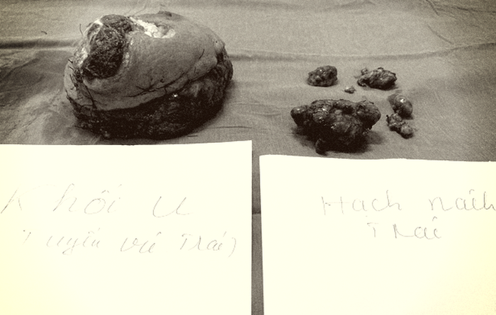 Khối u vú và hạch nách sau phẫu thuật của bệnh nhân. Ảnh: BVCC/VTV