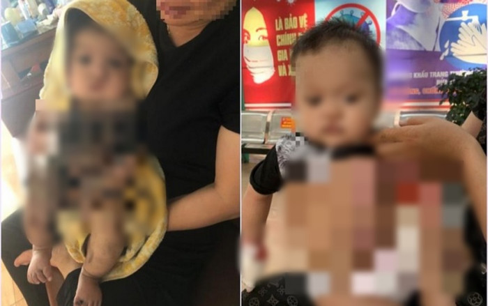 Gia đình đắp thuốc nam chữa bỏng khiến cháu bé 6 tháng tuổi bị nhiễm trùng nhập viện Ảnh 2