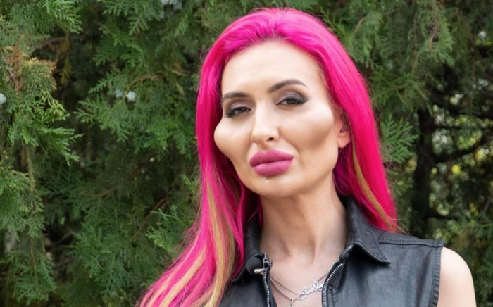 Bị bác sĩ cấm cửa, nàng mẫu nghiện 'bơm vá' vẫn tha thiết muốn được tiêm filler Ảnh 2