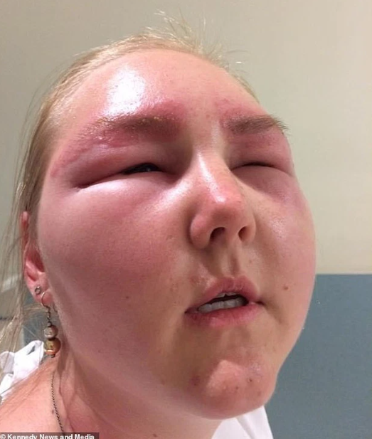 Cô dâu suýt bị mù vĩnh viễn vì ham nhuộm lông mày Ảnh 6