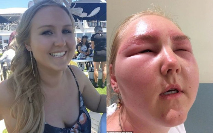 Cô dâu suýt bị mù vĩnh viễn vì ham nhuộm lông mày Ảnh 2