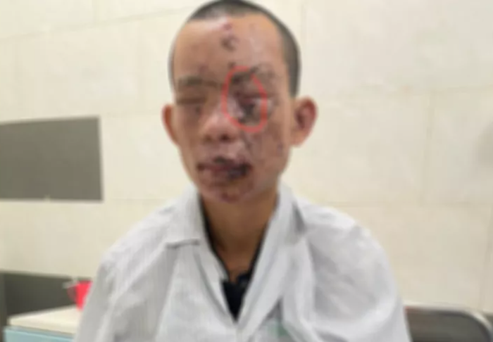 Vừa chơi điện thoại vừa sạc khiến vật phát nổ, nam thanh niên phải trả giá quá đắt khi mới 23 tuổi Ảnh 3