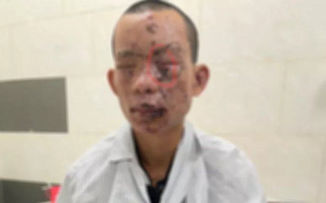 Vừa chơi điện thoại vừa sạc khiến vật phát nổ, nam thanh niên phải trả giá quá đắt khi mới 23 tuổi Ảnh 2