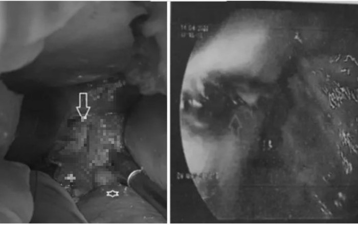 Sau bữa nhậu tại nhà, người đàn ông bị vỡ thực quản nhập viện cấp cứu Ảnh 2