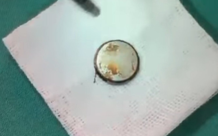 Bé 3 tuổi quấy khóc, nôn mửa được gia đình đưa vào bệnh viện, phát hiện một vật trong thực quản Ảnh 2