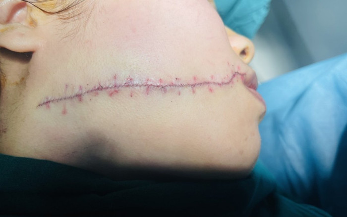 Cãi vã khi nói lời chia tay, cô gái 22 tuổi bị bạn trai chém rách mặt Ảnh 2