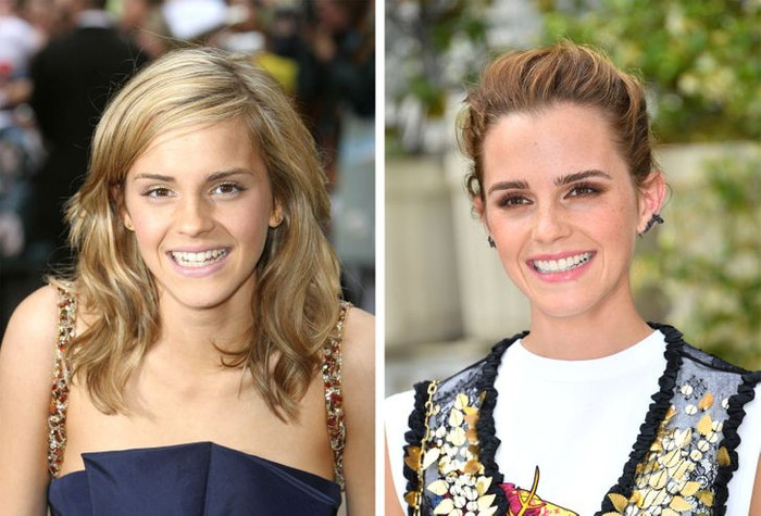Emma Watson cũng phải chỉnh lại răng để có khuôn miệng cười hoàn hảo.