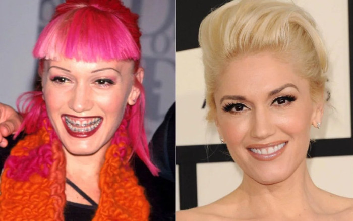 Dàn celeb sở hữu nụ cười 'lịm tim' hóa ra từng có hàm răng nhấp nhổm 'ma chê quỷ hờn' Ảnh 2