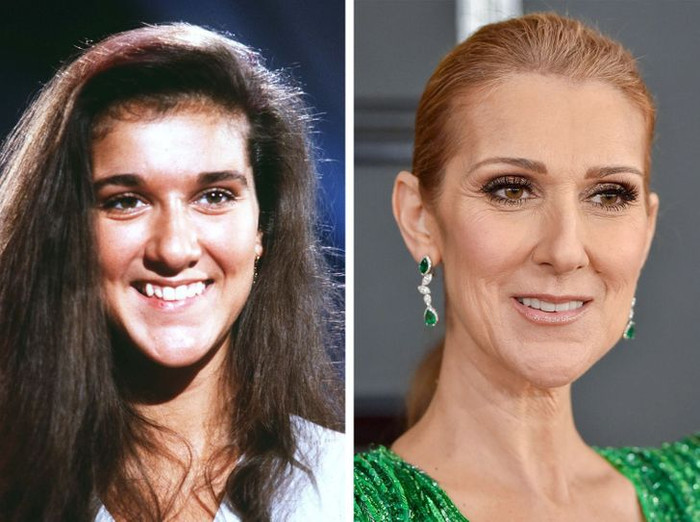 Céline Dion không thích chiếc răng khểnh cũ của mình. 