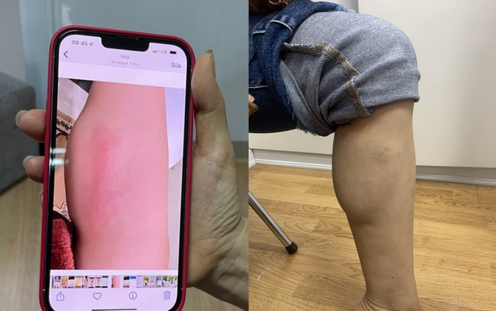 Chi 60 triệu tiêm 'collagen tươi' để làm thẳng chân, bắp chân người phụ nữ biến thành ổ áp xe Ảnh 2