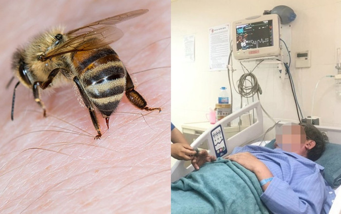 Bị ong vò vẽ đốt, người đàn ông bị sốc phản vệ nguy kịch Ảnh 2