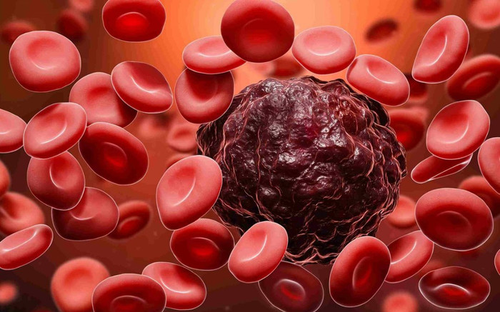 Cảnh báo ung thư máu: Các triệu chứng cúm có thể là dấu hiệu của bệnh Ảnh 2