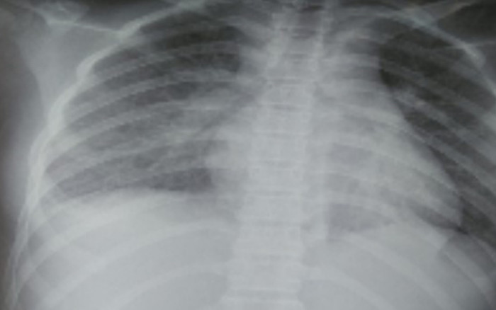 Sau 2 tuần khỏi Covid-19 bé gái đi học lại bình thường nhưng bất ngờ rơi vào nguy kịch Ảnh 2