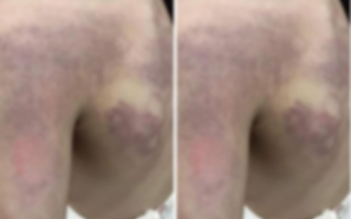 Học trò lớp 3 bị bầm tím vai và lưng nghi do cô giáo đánh Ảnh 2