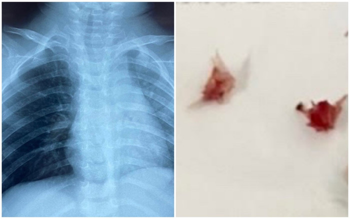 Bé trai đang ăn cháo lươn thì ho sặc sụa, tím tái phải nhập viện cấp cứu Ảnh 2