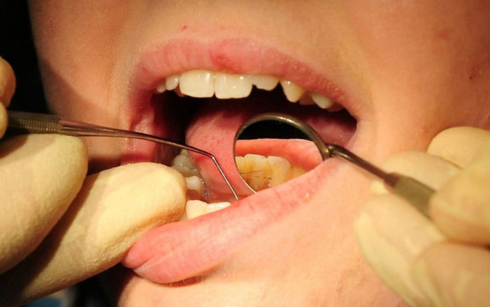 Những vấn đề răng miệng không nên bỏ qua vì chúng có thể cứu mạng của bạn Ảnh 2