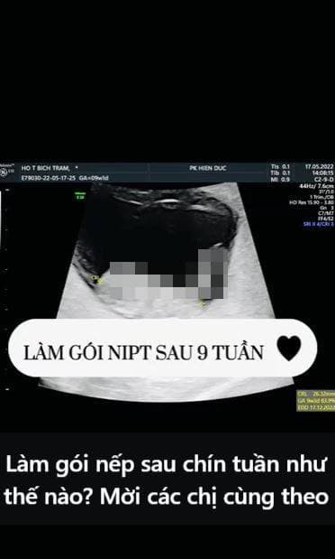 Nữ diễn viên khoe ảnh siêu âm tới khán giả trên trang cá nhân