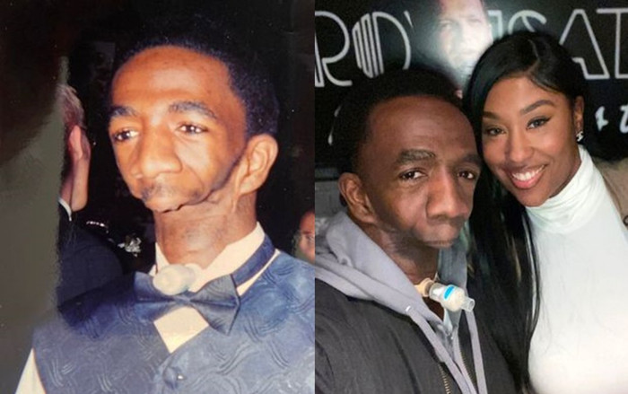 Nghị lực phi thường của người đàn ông sinh ra không có hàm Ảnh 2