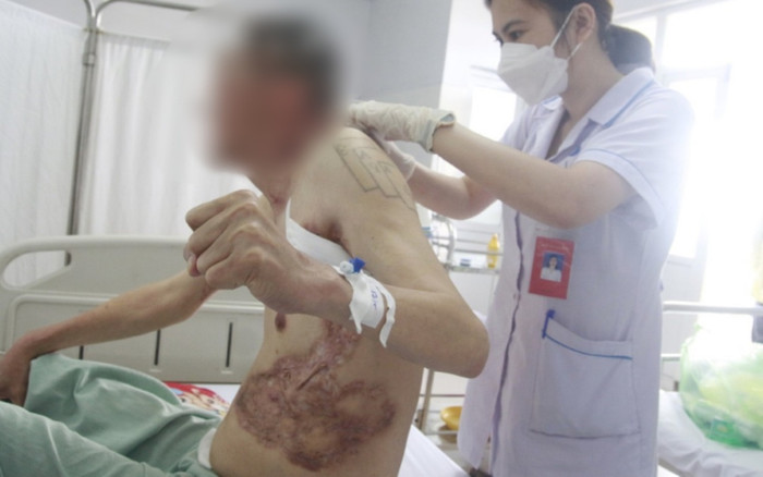 Người đàn ông bị lở loét, sẹo khắp người vì mồ hôi tiết ra mủ hiếm gặp Ảnh 2