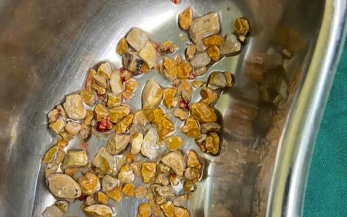 Đau bụng nhiều tháng, người đàn ông nhập viện và được phẫu thuật lấy ra 'cả rổ' sỏi thận Ảnh 2