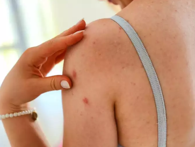 Cả đậu mùa khỉ và Covid-19 đều có thể gồm triệu chứng phát ban.