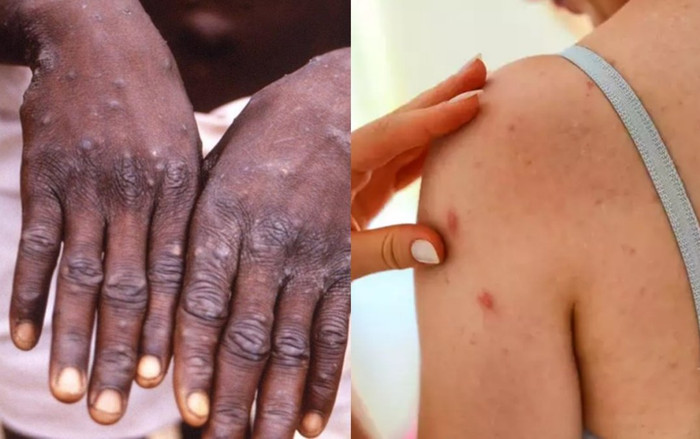 Đều gây ra vấn đề về da, làm thế nào phân biệt Covid-19 và bệnh đậu mùa khỉ? Ảnh 2