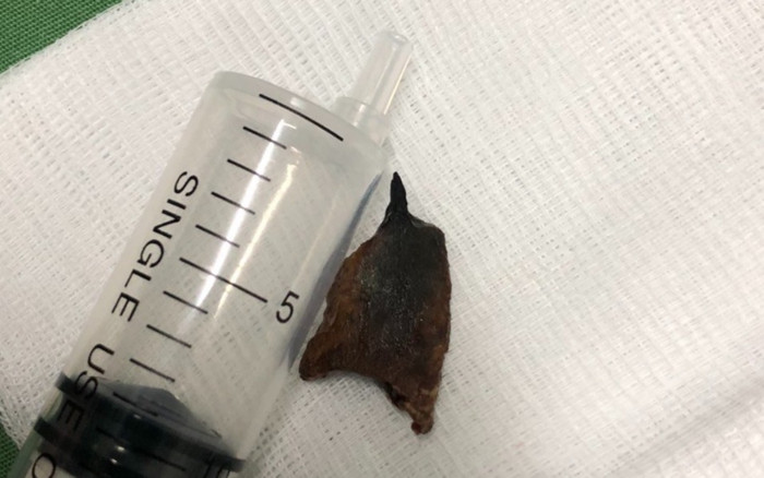 Ho ra máu có mủ đi chữa suốt 20 năm không khỏi, sau cùng bác sĩ gắp ra thứ này từ phế quản bệnh nhân Ảnh 2