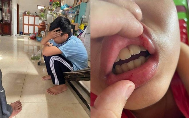 Nam sinh lớp 6 bị nhóm bạn cùng trường đánh hội đồng nhiều lần trong nhà vệ sinh Ảnh 2