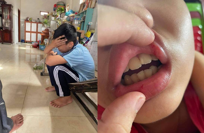 Em N. bị đánh chấn thương. Ảnh: Thiên Long/Dân Việt