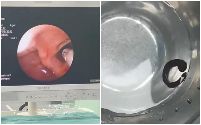 Gắp thành công con vắt rừng dài 8cm trốn trong đường thở của bệnh nhi 6 tuổi Ảnh 2