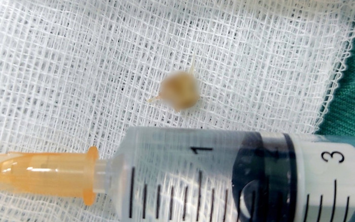 Hồi hộp cấp cứu bệnh nhi 2 tuổi có mảnh xương cá sắc nhọn trong đường thở Ảnh 2