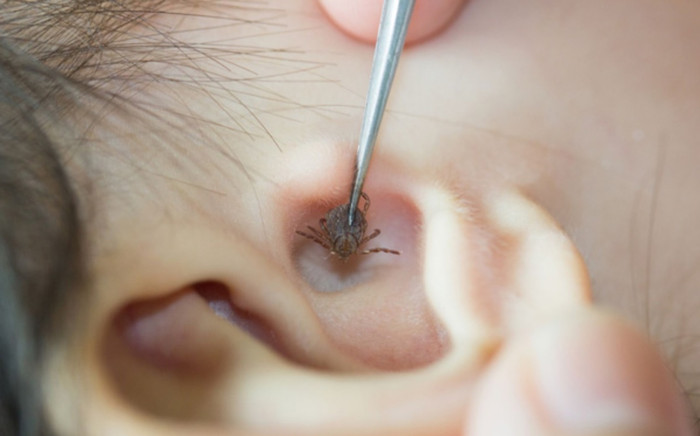 Thường xuyên ôm ấp chó cưng, bé trai 5 tuổi bị ve chó làm ổ dày đặc trong tai Ảnh 2