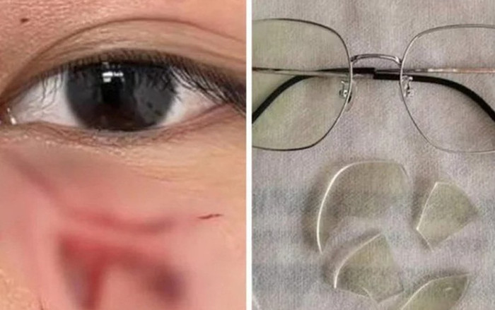 Thầy giáo đấm học sinh rách mắt, phải khâu 16 mũi vì một lý do khiến dân tình 'sôi máu' Ảnh 2