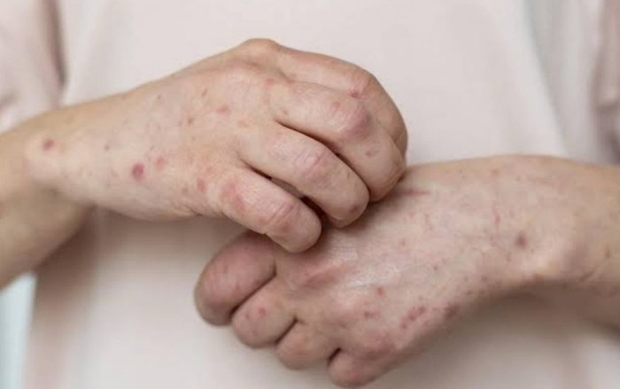 Đậu mùa khỉ lây qua đường tình dục? Ảnh 2